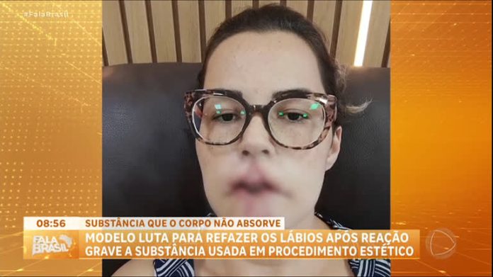 Entenda os riscos do PMMA, substância usada em procedimento estético - RecordTV