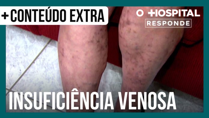 Cirurgião vascular explica quais são as causas da insuficiência venosa | O Hospital Responde - Conteúdo Exclusivo