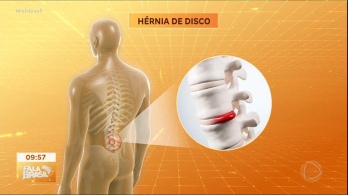 Hérnia de disco faz milhões de pessoas se afastarem do trabalho - RecordTV